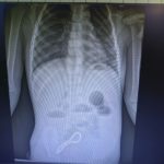 Рязанские хирурги спасли трехлетнего малыша, который проглотил магнитный браслет