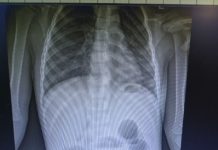 Рязанские хирурги спасли трехлетнего малыша, который проглотил магнитный браслет