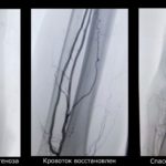 Благодаря рязанским врачам мужчине удалось избежать ампутации ноги