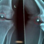 Рязанские хирурги прооперировали мужчину с осколком в ноге, который чудом на затронул вену