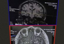 Рязанские врачи помогли 80-летней женщине восстановиться после инсульта