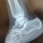 За неделю больше 600 человек стали пациентами травмцентра рязанской БСМП