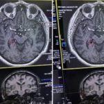 Рязанские врачи спасли пациентку с инсультом